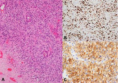 Case report: ATIC-ALK fusion in infant-type hemispheric glioma and response to lorlatinib